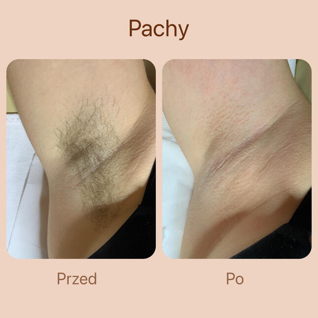 Gładka skóra pod pachami po depilacji pastą cukrową.