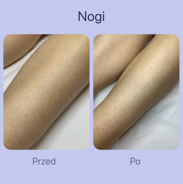 Depilacja nóg pastą cukrową u kobiety, która wcześniej poddała się depilacji laserowej, ale włosy zaczęły odrastać.